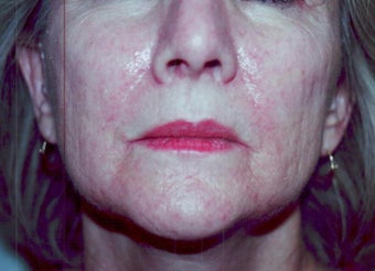 SmartXide CO2 Laser Resurfacing (DOT Therapy) 587714