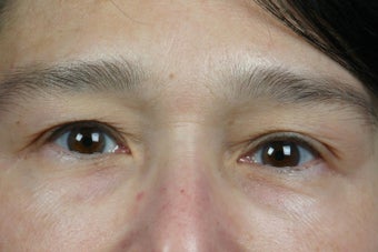 Restylane to Tear Trough after 308294