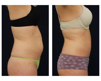 Liposuction 396991