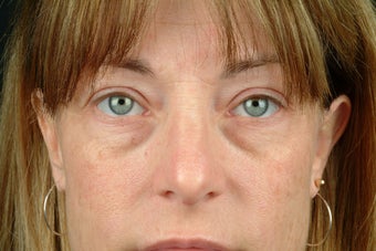 Restylane before 531619