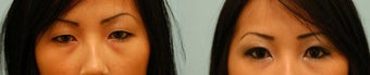 Asian Blepharoplasty ("Double Eyelid" Procedure) before 136815