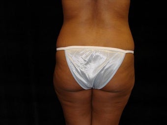 Brazilian Buttocks Lift before 246916