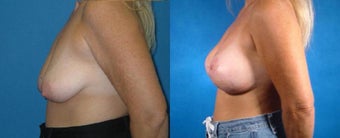 Breast Lift with Implants before 101826