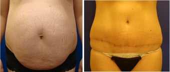 Tummy Tuck before 240526
