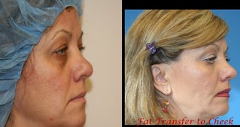 Fat transfer or fat grafting with PRP before 252413