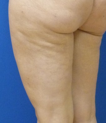 Cellulaze 571582