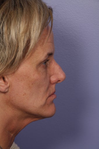 Botox before 333884