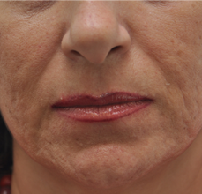 Acne Scarring before 426030
