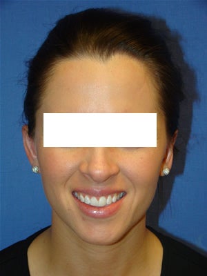 Otoplasty (Ear Surgery) after 152800