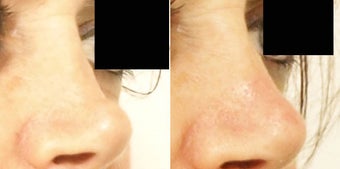 Non surgical rhinoplasty before 634593