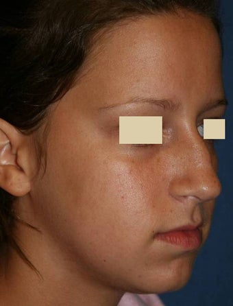 Rhinoplasty before 142566
