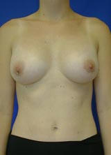 Breast Augmentation Surgery after 157909