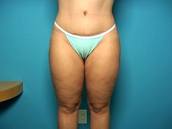 Liposuction and Abdominoplasty after 134587