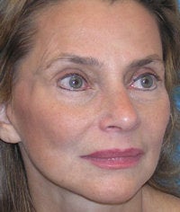 Midfacial Rejuvenation after 52478