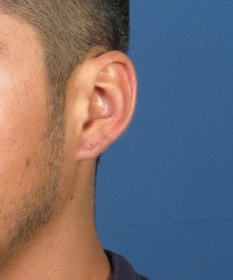 Gauge Earring Repair Otoplasty Surgery 617423