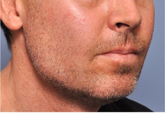 Jawline Augmentation after 524379