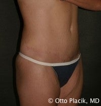 Abdominoplasty after 565832