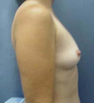 Breast Augmentation before 131657