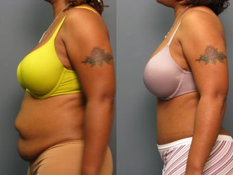 Tummy tuck after 264466