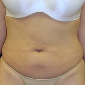 Thermage Abdomen before 213721
