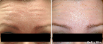 Botox before 273783