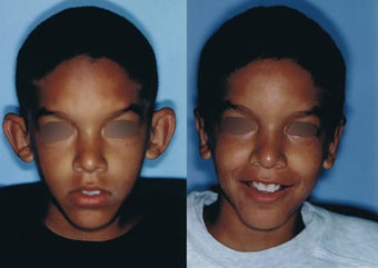 Otoplasty for Protruding Ears before 117347