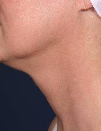 Fraxel - neck after 136747