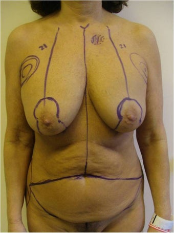 Breast Lift and Abdominoplasty before 302927