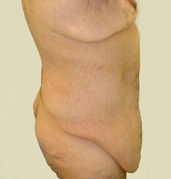 Bodylift & removal of excess chest skin 527247