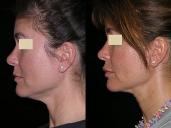 Smart Liposuction of the neck before 143601