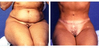 Tummy Tuck before 318683