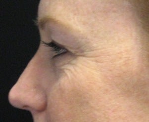 Fraxel CO2 Laser Resurfacing before 221155