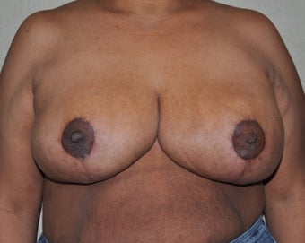 Breast Reduction after 530711
