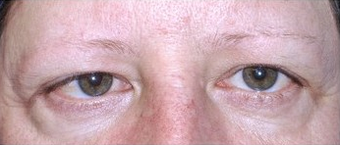 Brow Lift with lower blepharoplasty (lower eyelids) before 143523