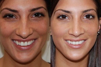 Rhinoplasty Surgery before 206913
