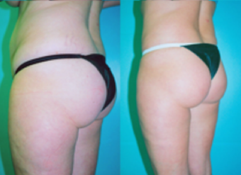 Tummy Tuck with Liposuction before 263632