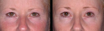 Ultherapy before 460619