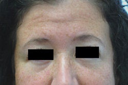 Botox for forehead lines before 93347