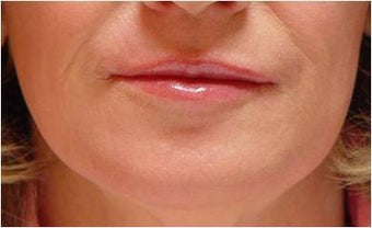 Smokers Lines Treatment after 255557