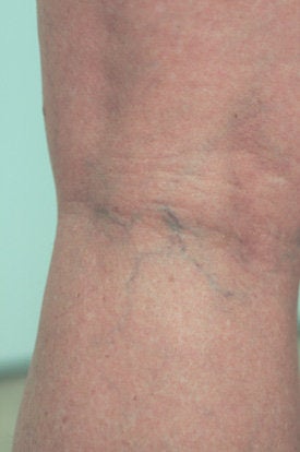 Laser Spider Vein Removal before 106560