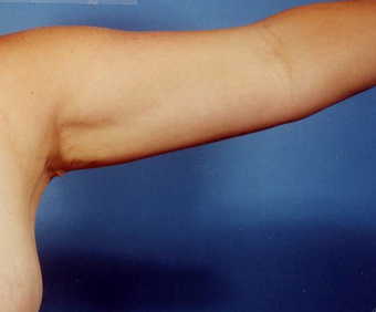 Arm Lift after 230659