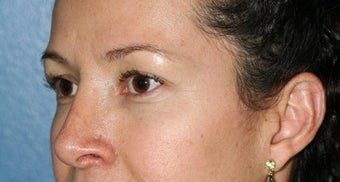 Rhinoplasty Gallery after 129737