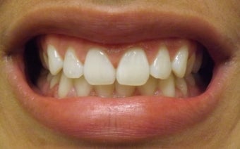 Zoom Teeth Whitening Before and After Photos after 616971