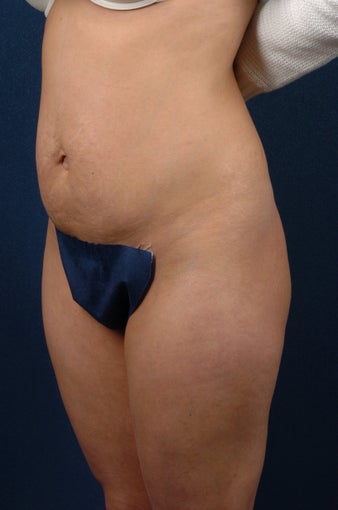 Abdominoplasty (tummy tuck) before 267681