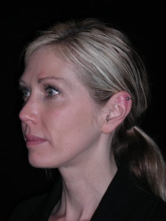 Filler injection perioral area after 226708