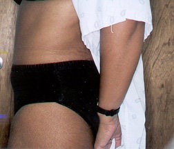Tummy Tuck after 234036