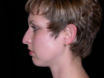 Rhinoplasty and Chin Implants before 257839