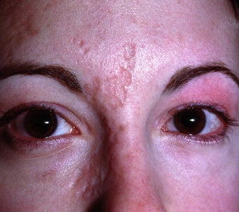 Liquid Injectable Silicone before 417387