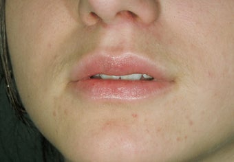 Lip augmentation after 115102