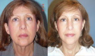 Lower Facelift, Brow Re-positioning, Upper Eyelid Surgery before 366963
